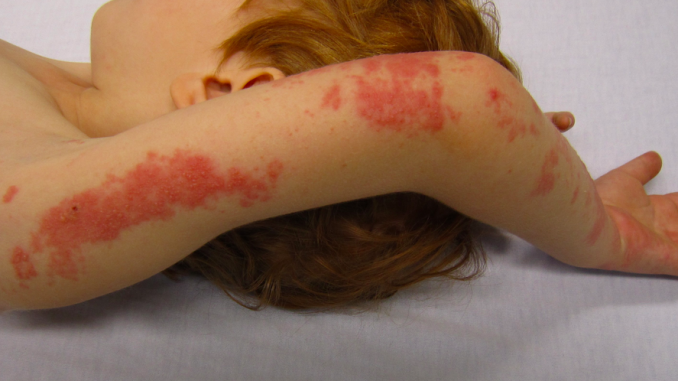 Chicken Pox Rash