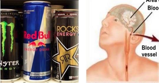 Energy Drinks Increase Srokes 500 Percent