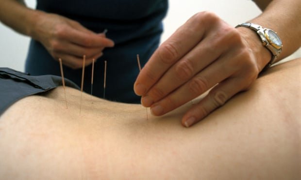 Accupuncture