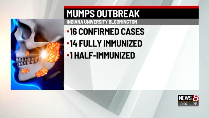 Indiana University Mumps Outbreak