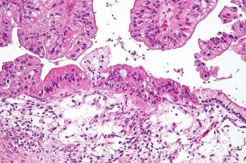 Changes in the metabolism of normal cells promotes the metastasis of ovarian cancer cells