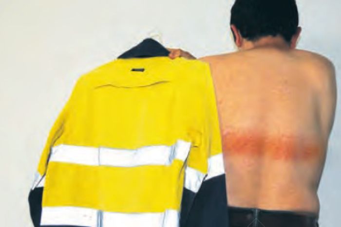 Engineer suffers first-degree burns from high-vis shirt, sparking medical warning