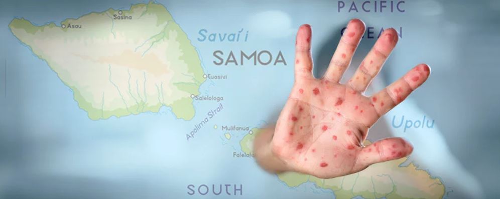 Measles_In_Samoa