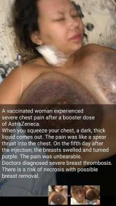 Severe Breast Thrombosis