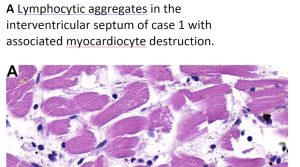 Damaged Heart Muscles Post Jab