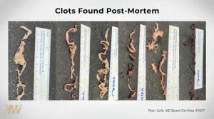 Clots Found Post Covid Jab