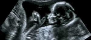Ultrasound
