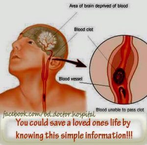 Stroke Diagram