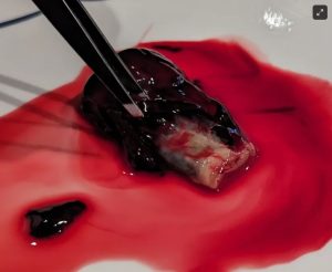Rubbery Clot of C19 Unvaccinated Individual