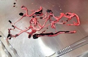 White Clots