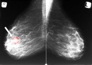 spontaneous regression breast cancer