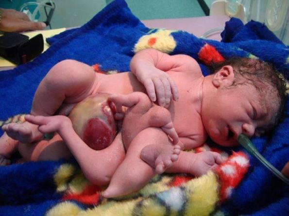 Congenital Defects