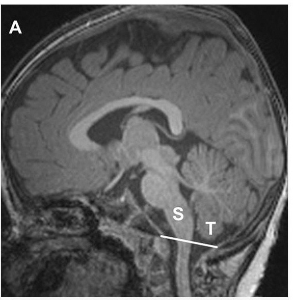Normal Brain MRI