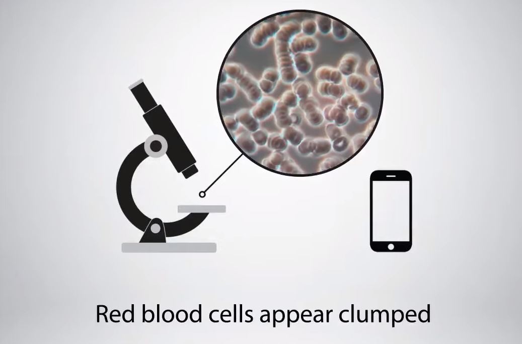 Clumped Red Blood Cells