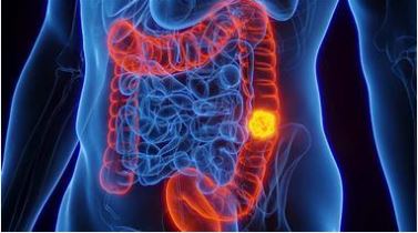Intestinal Problem