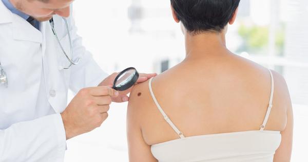Doctor Examines Melanoma