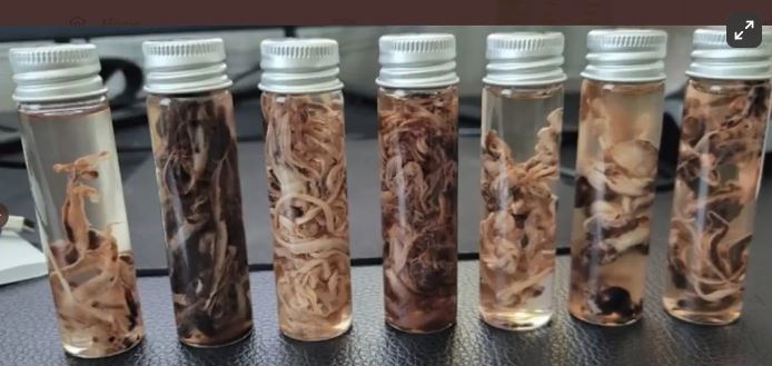 Misfolded Fibrin Protein Clots