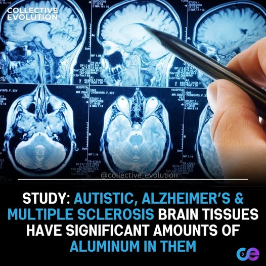 Aluminium In Brain