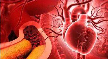 Arterial Plaque and Heart