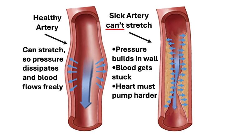 Healthy vs Sick Artery