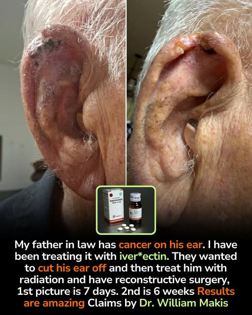 Ivermectin vs Skin Cancer