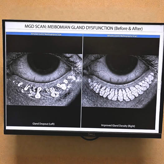 Meibomian Gland Dysfunction